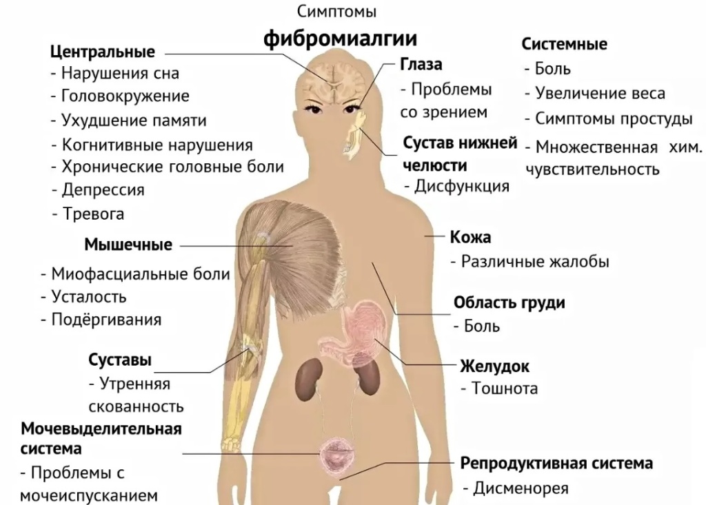 Фибромиалгия
